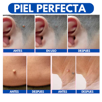 WART REMOVER - SERUM REMOVEDOR DE VERRUGAS